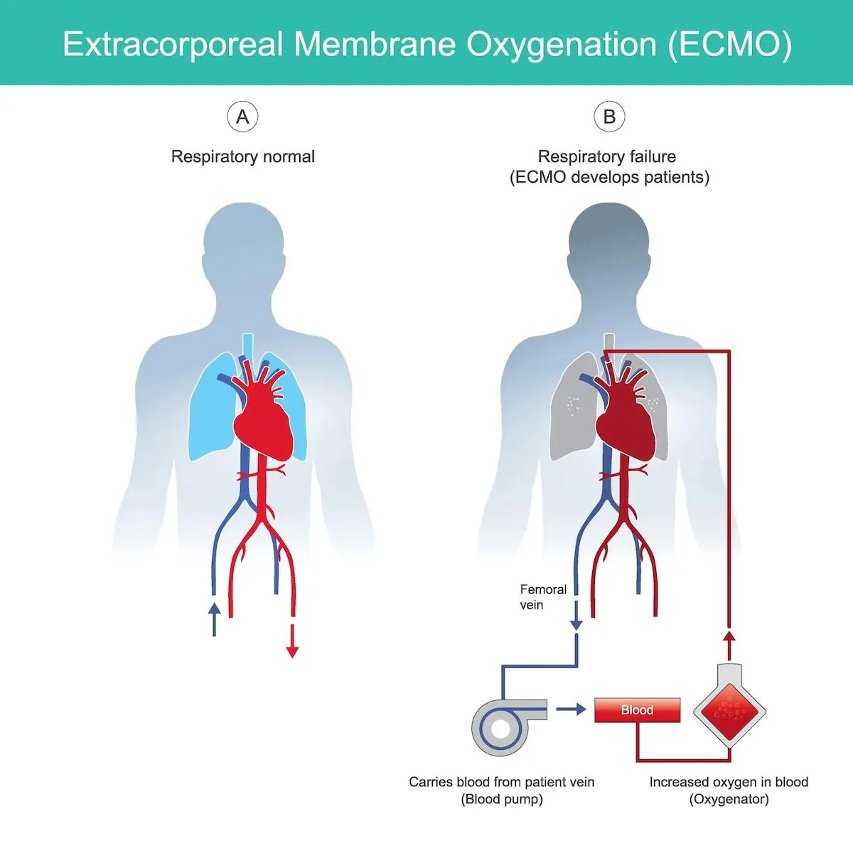 An illustration showing a normal respiratory system next to an illustration showing how ECMO helps patients experiencing respiratory failure