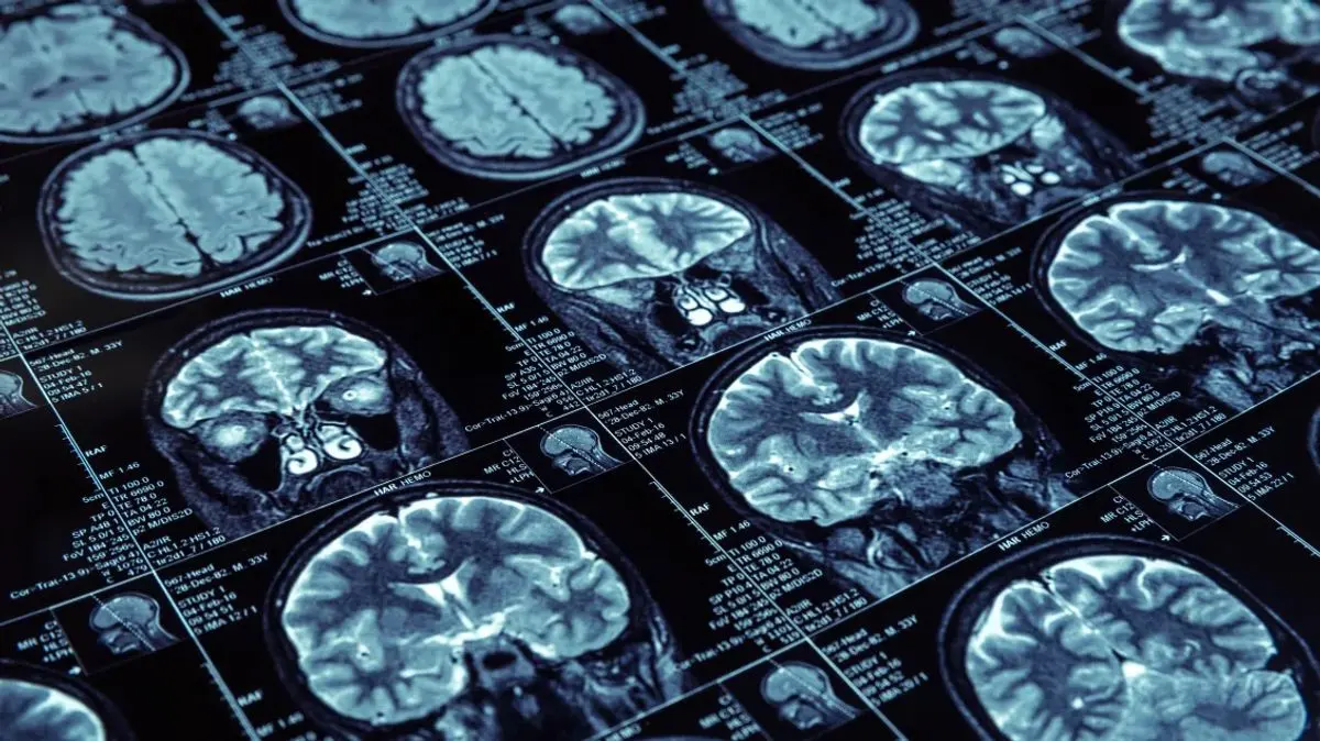 A series of blue-toned magnetic resonance imaging (MRI) brain scans